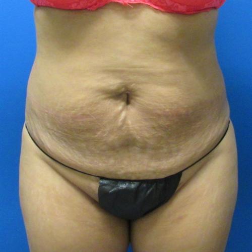 Tummy Tuck Before and After | SGK Plastic Surgery