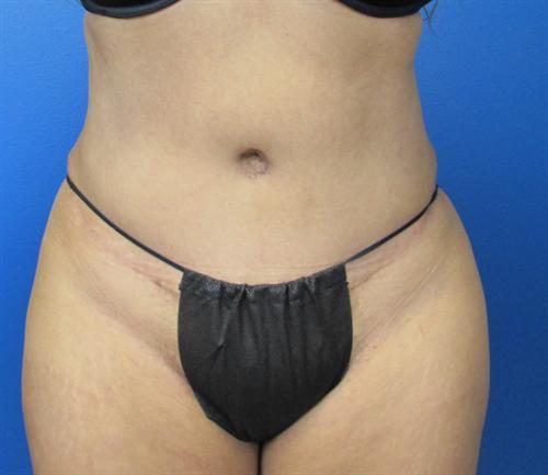 Tummy Tuck Before and After | SGK Plastic Surgery