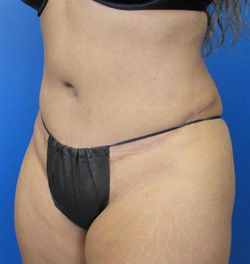 Tummy Tuck Before and After | SGK Plastic Surgery