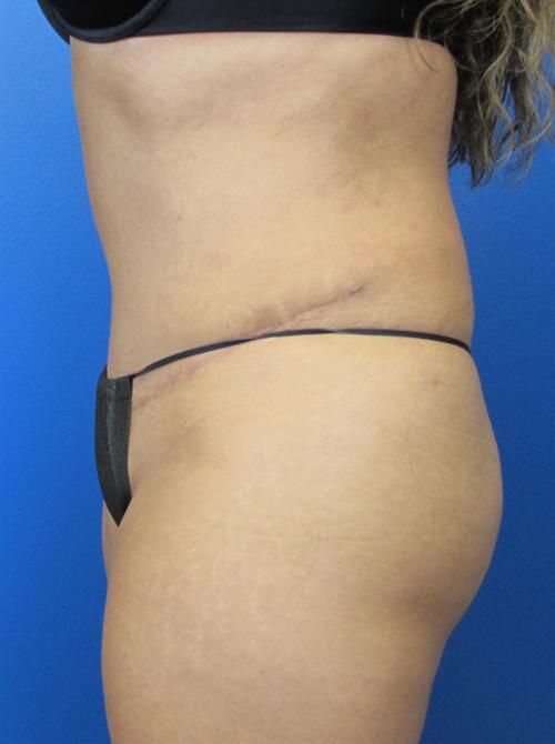 Tummy Tuck Before and After | SGK Plastic Surgery