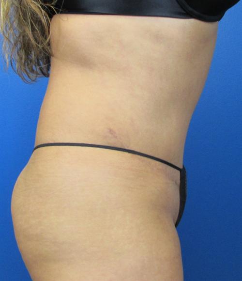 Tummy Tuck Before and After | SGK Plastic Surgery