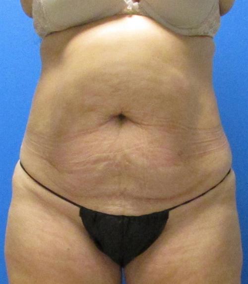 Tummy Tuck Before and After | SGK Plastic Surgery