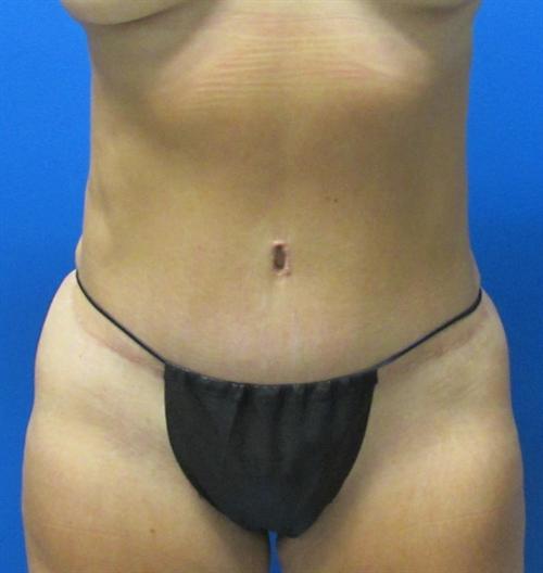 Tummy Tuck Before and After | SGK Plastic Surgery