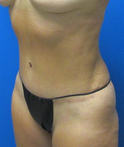 Tummy Tuck Before and After | SGK Plastic Surgery