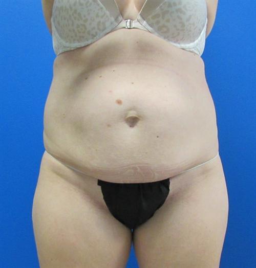 Tummy Tuck Before and After | SGK Plastic Surgery