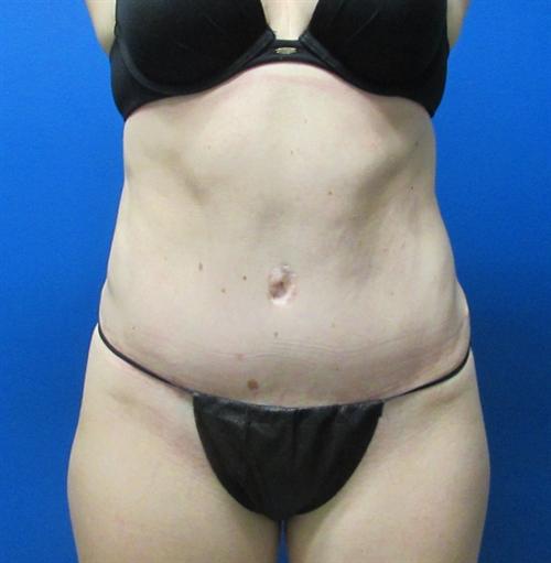 Tummy Tuck Before and After | SGK Plastic Surgery