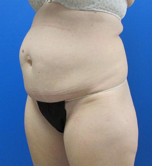 Tummy Tuck Before and After | SGK Plastic Surgery