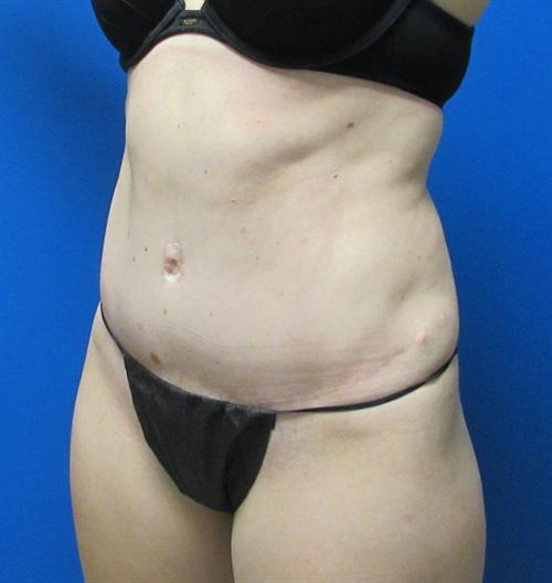 Tummy Tuck Before and After | SGK Plastic Surgery