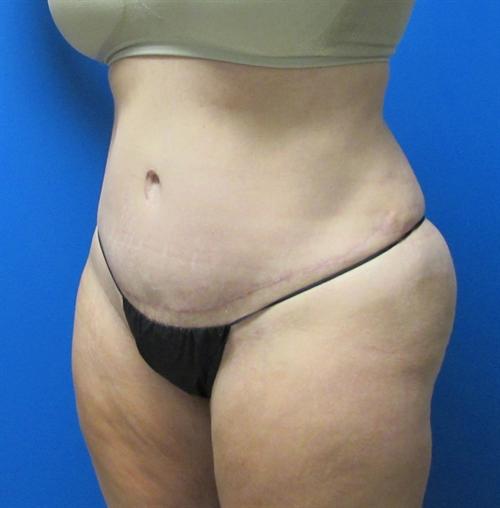 Tummy Tuck Before and After | SGK Plastic Surgery