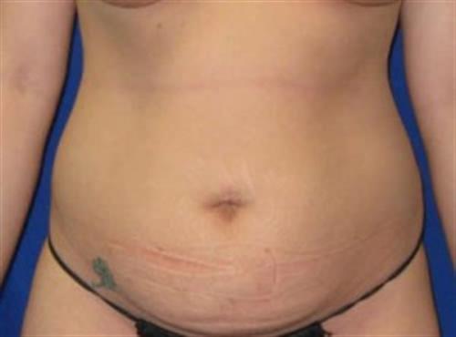 Tummy Tuck Before and After | SGK Plastic Surgery