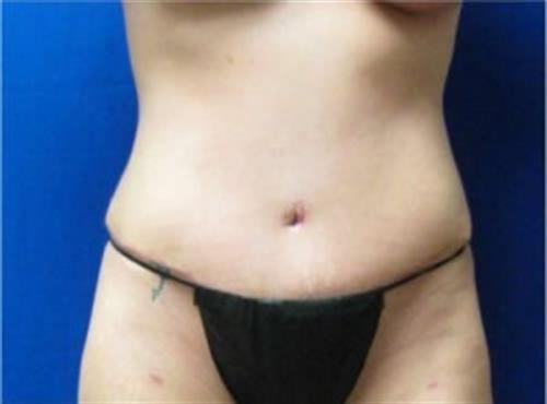 Tummy Tuck Before and After | SGK Plastic Surgery