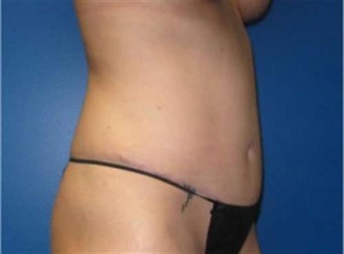 Tummy Tuck Before and After | SGK Plastic Surgery