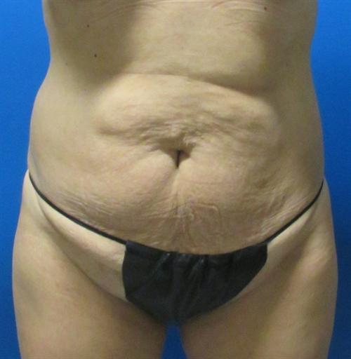 Tummy Tuck Before and After | SGK Plastic Surgery