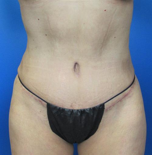 Tummy Tuck Before and After | SGK Plastic Surgery