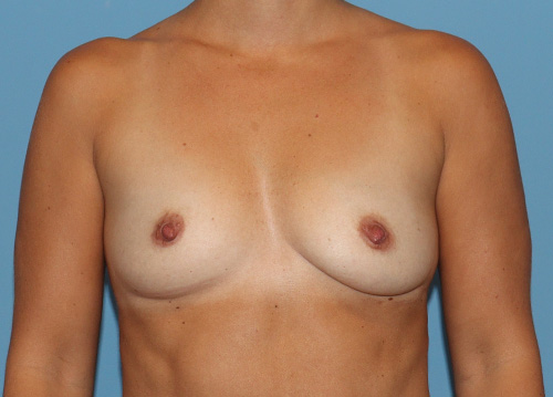 Breast Augmentation Before and After | SGK Plastic Surgery