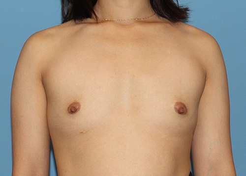 Breast Augmentation Before and After | SGK Plastic Surgery