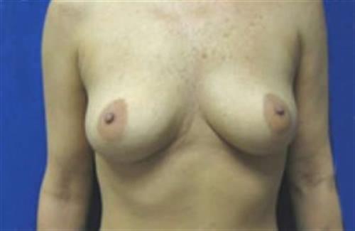 Breast Augmentation Before and After | SGK Plastic Surgery