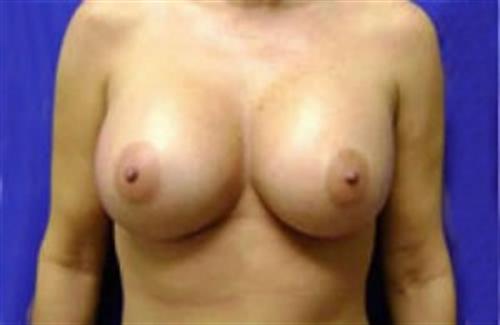 Breast Augmentation Before and After | SGK Plastic Surgery