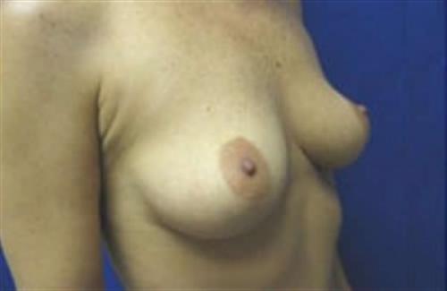 Breast Augmentation Before and After | SGK Plastic Surgery