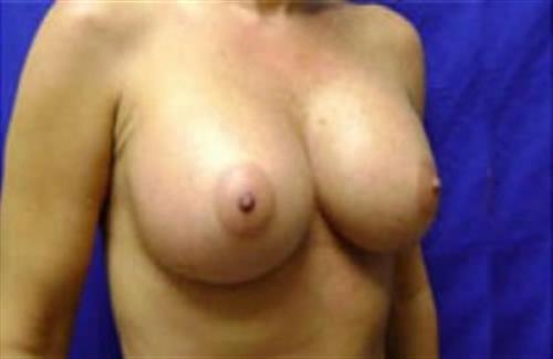 Breast Augmentation Before and After | SGK Plastic Surgery