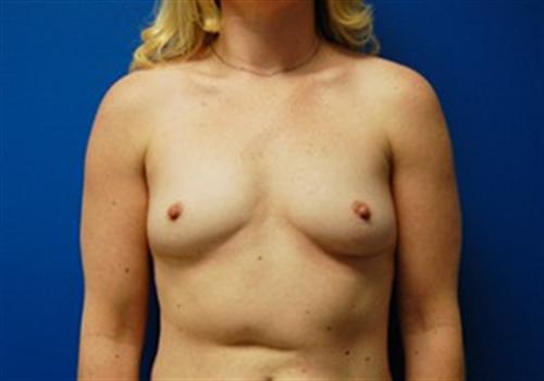 Breast Augmentation Before and After | SGK Plastic Surgery