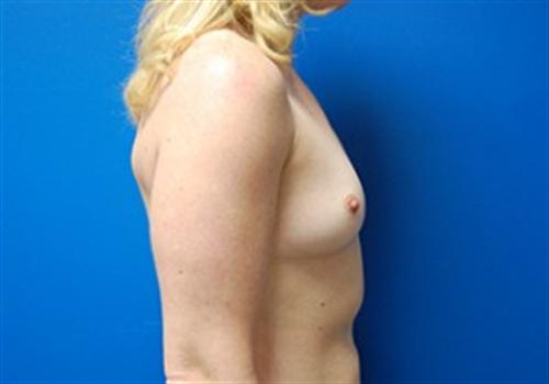 Breast Augmentation Before and After | SGK Plastic Surgery