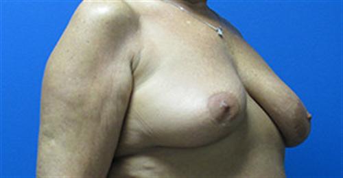 Breast Augmentation Before and After | SGK Plastic Surgery