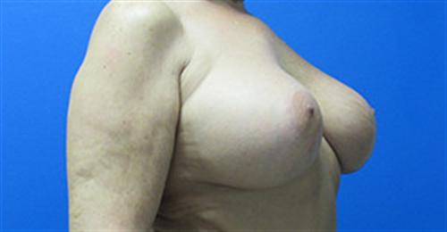 Breast Augmentation Before and After | SGK Plastic Surgery