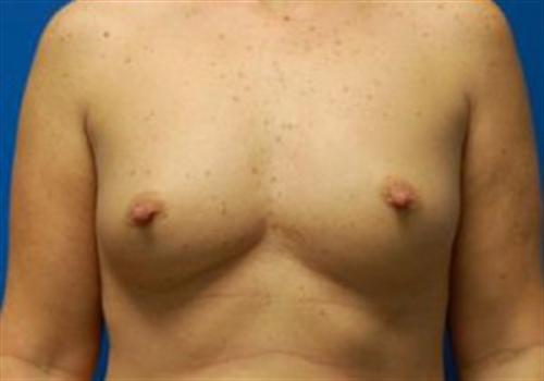 Breast Augmentation Before and After | SGK Plastic Surgery