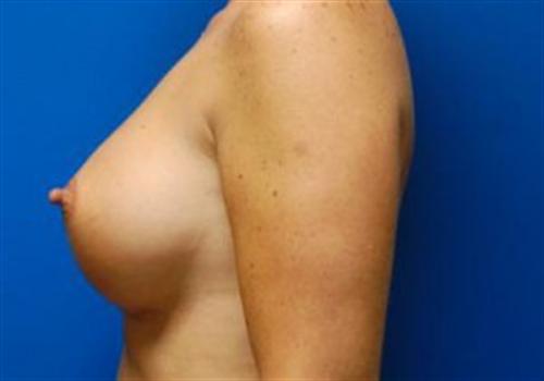 Breast Augmentation Before and After | SGK Plastic Surgery