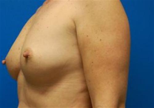 Breast Augmentation Before and After | SGK Plastic Surgery