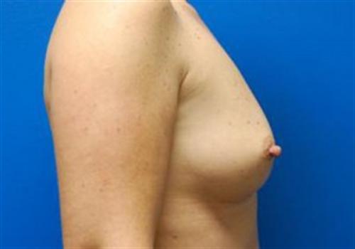 Breast Augmentation Before and After | SGK Plastic Surgery