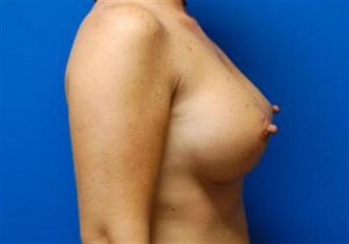 Breast Augmentation Before and After | SGK Plastic Surgery