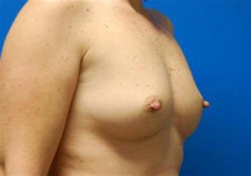 Breast Augmentation Before and After | SGK Plastic Surgery