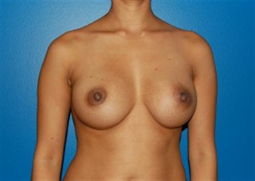 Breast Augmentation Before and After | SGK Plastic Surgery