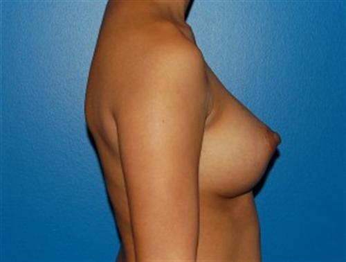 Breast Augmentation Before and After | SGK Plastic Surgery