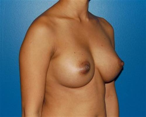 Breast Augmentation Before and After | SGK Plastic Surgery