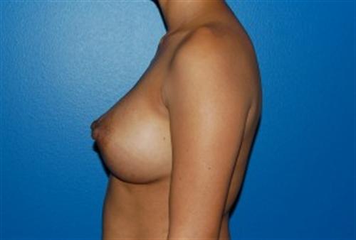 Breast Augmentation Before and After | SGK Plastic Surgery