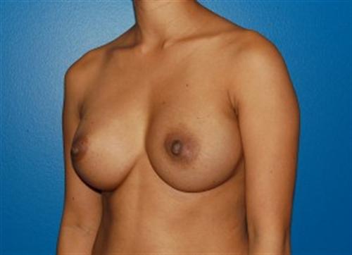 Breast Augmentation Before and After | SGK Plastic Surgery