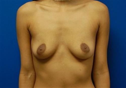 Breast Augmentation Before and After | SGK Plastic Surgery