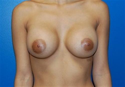 Breast Augmentation Before and After | SGK Plastic Surgery