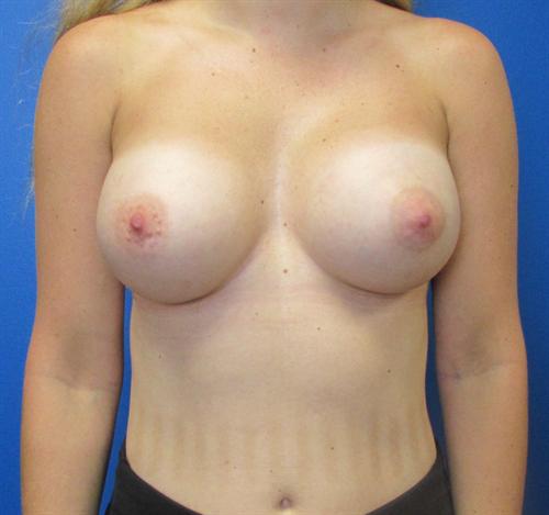 Breast Augmentation Before and After | SGK Plastic Surgery