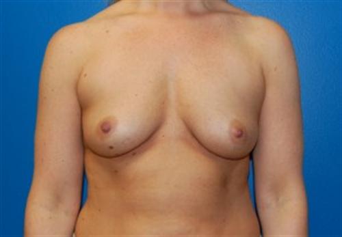 Breast Augmentation Before and After | SGK Plastic Surgery