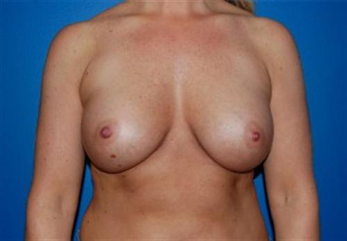 Breast Augmentation Before and After | SGK Plastic Surgery