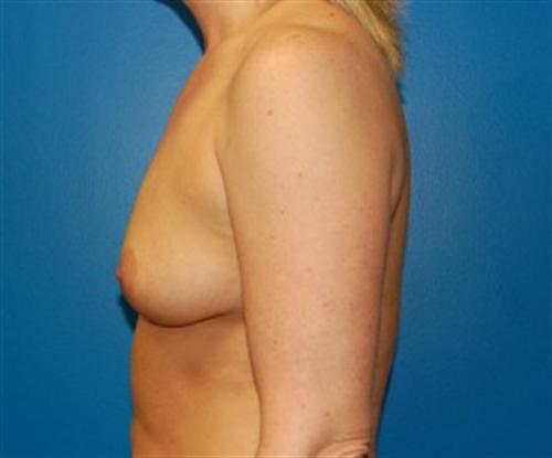 Breast Augmentation Before and After | SGK Plastic Surgery