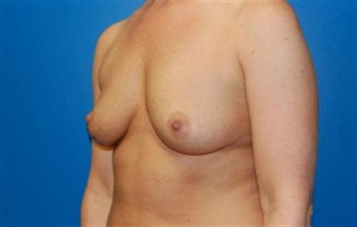 Breast Augmentation Before and After | SGK Plastic Surgery