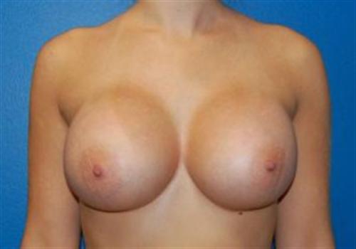 Breast Augmentation Before and After | SGK Plastic Surgery