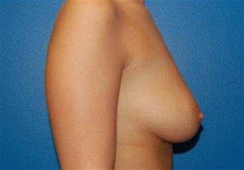 Breast Augmentation Before and After | SGK Plastic Surgery