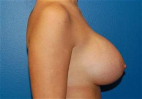 Breast Augmentation Before and After | SGK Plastic Surgery