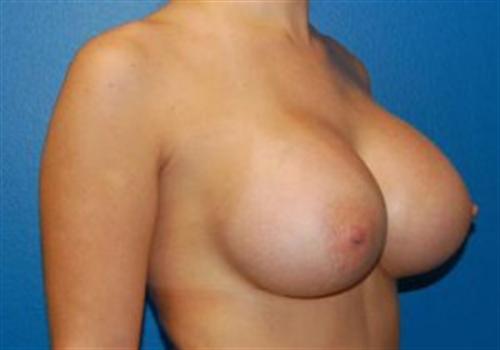 Breast Augmentation Before and After | SGK Plastic Surgery